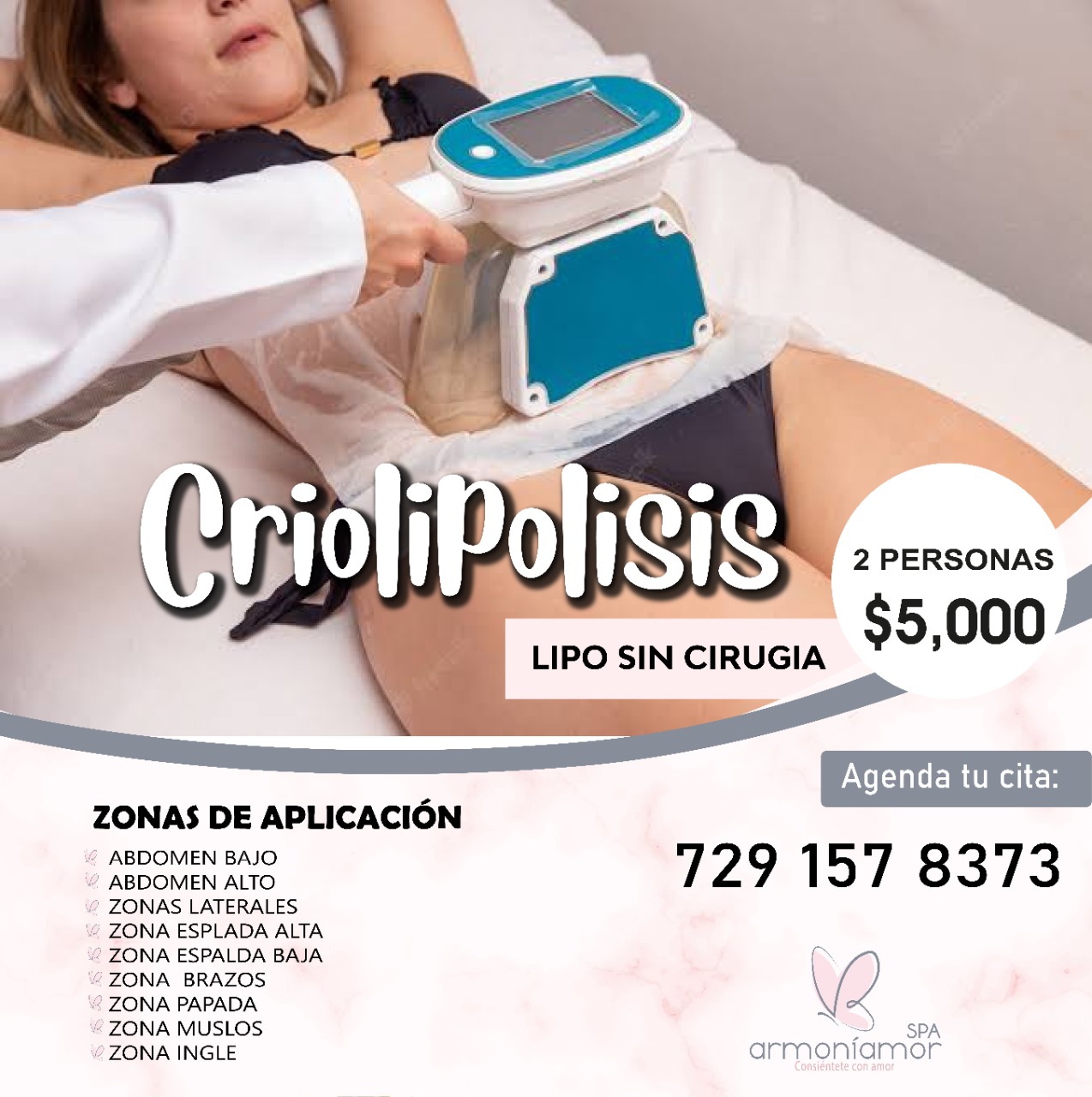 Criolipolisis en Toluca